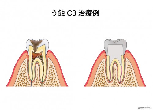 むし歯　Ｃ3